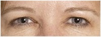 Botox and Dermal Fillers wrinkle removal at Kingswood Clinic in Blackburn 378608 Image 4